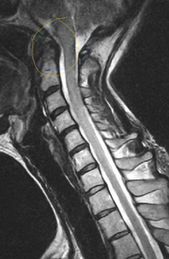Cervical MRI with the anterior pannus circled at the craniocervical junction