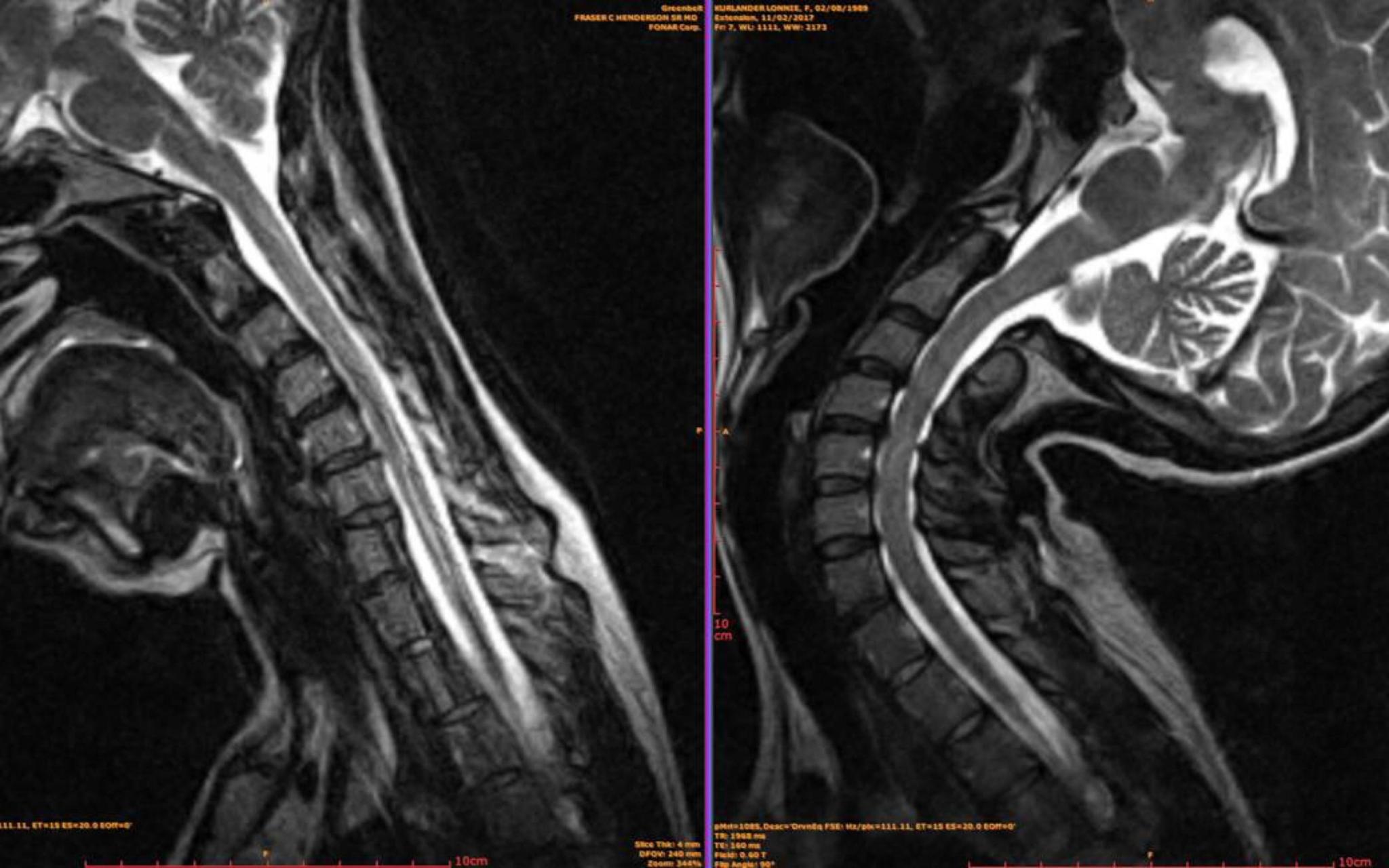 Spinal hypermobility in Ehlers-Danlos syndrome — flexion-extension MRI